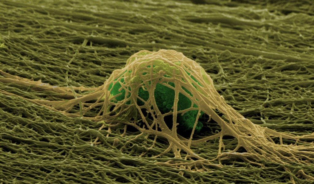 Electrospinning bone implants